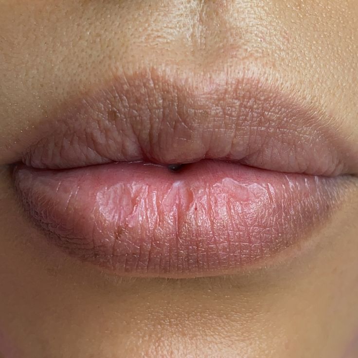 Dark & Chapped Lips