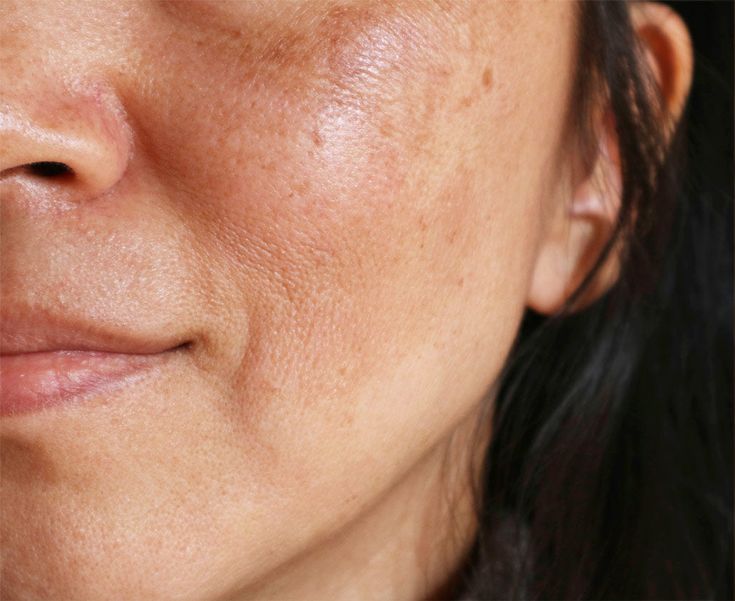 Pigmentation & Dark Circles