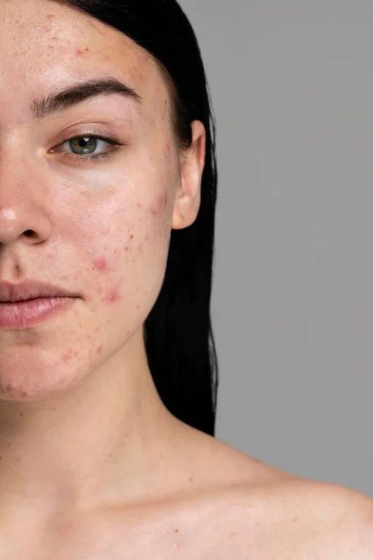 Oily & Acne Prone Skin