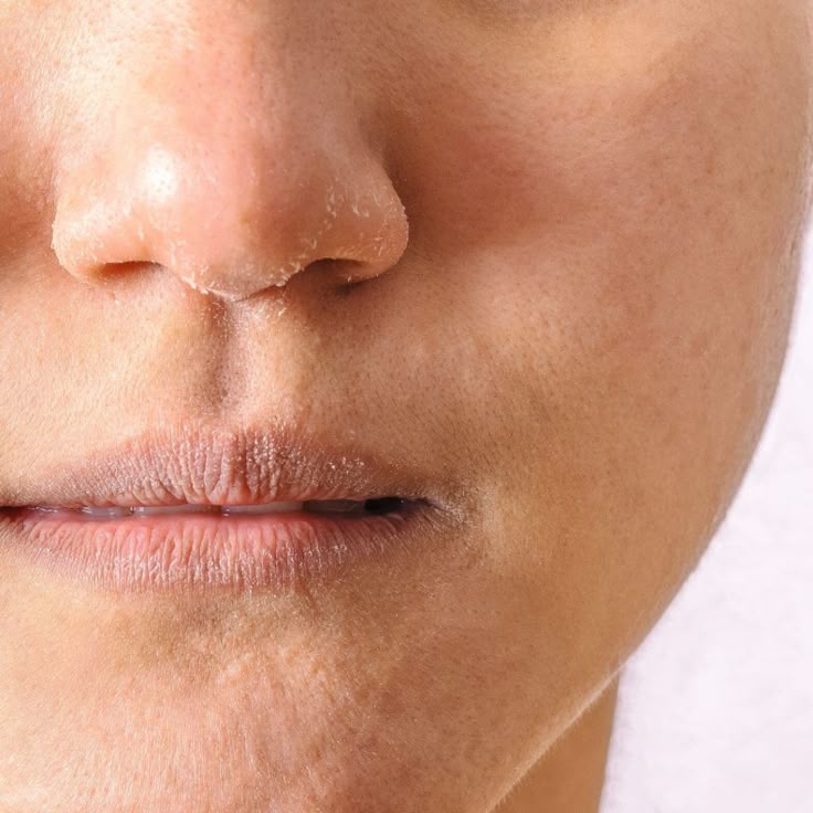 Dull & Dry Skin